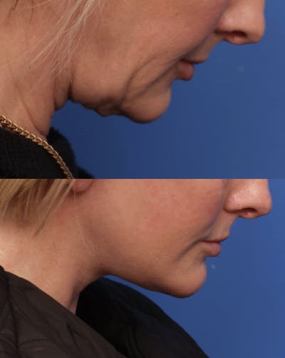 Deep Plane Facelift Before & After Gallery - Patient 488900 - Image 1