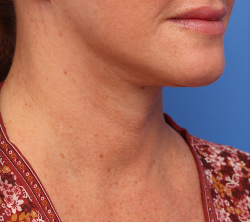 Deep Plane Facelift Before & After Gallery - Patient 134702 - Image 6