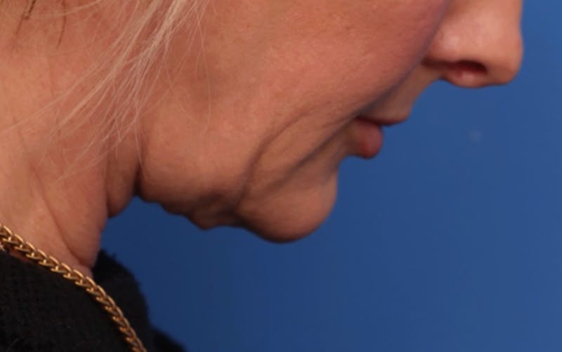 Deep Plane Facelift Before & After Gallery - Patient 488900 - Image 1