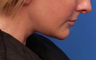 Deep Plane Facelift Before & After Gallery - Patient 488900 - Image 2