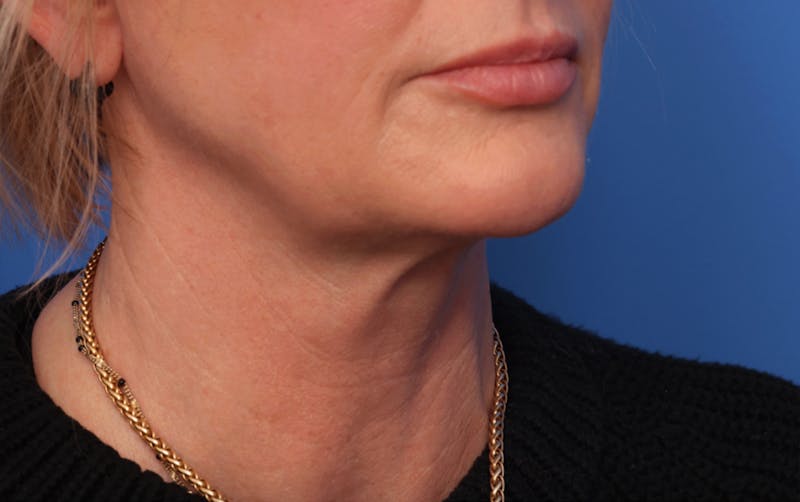 Deep Plane Facelift Before & After Gallery - Patient 488900 - Image 3