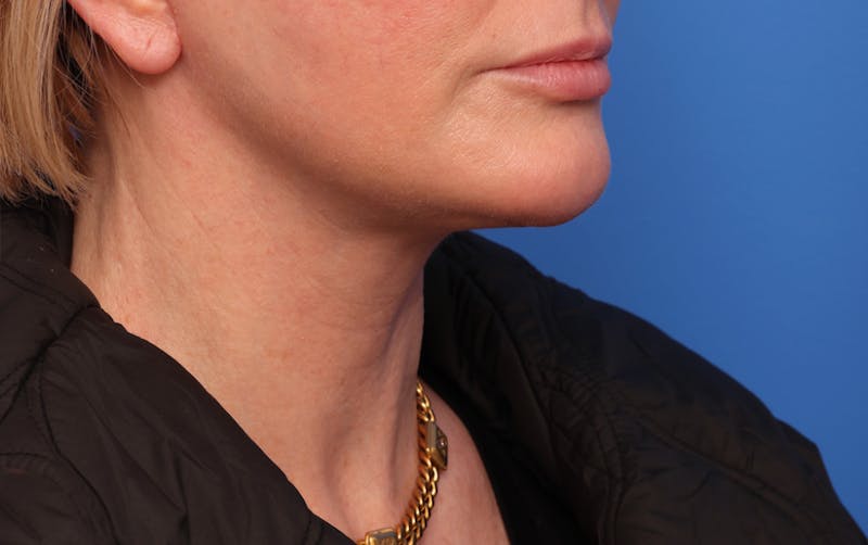 Deep Plane Facelift Before & After Gallery - Patient 488900 - Image 4