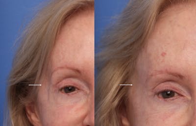 Injectables (Botox, Filler, etc.) Before & After Gallery - Patient 212607 - Image 1
