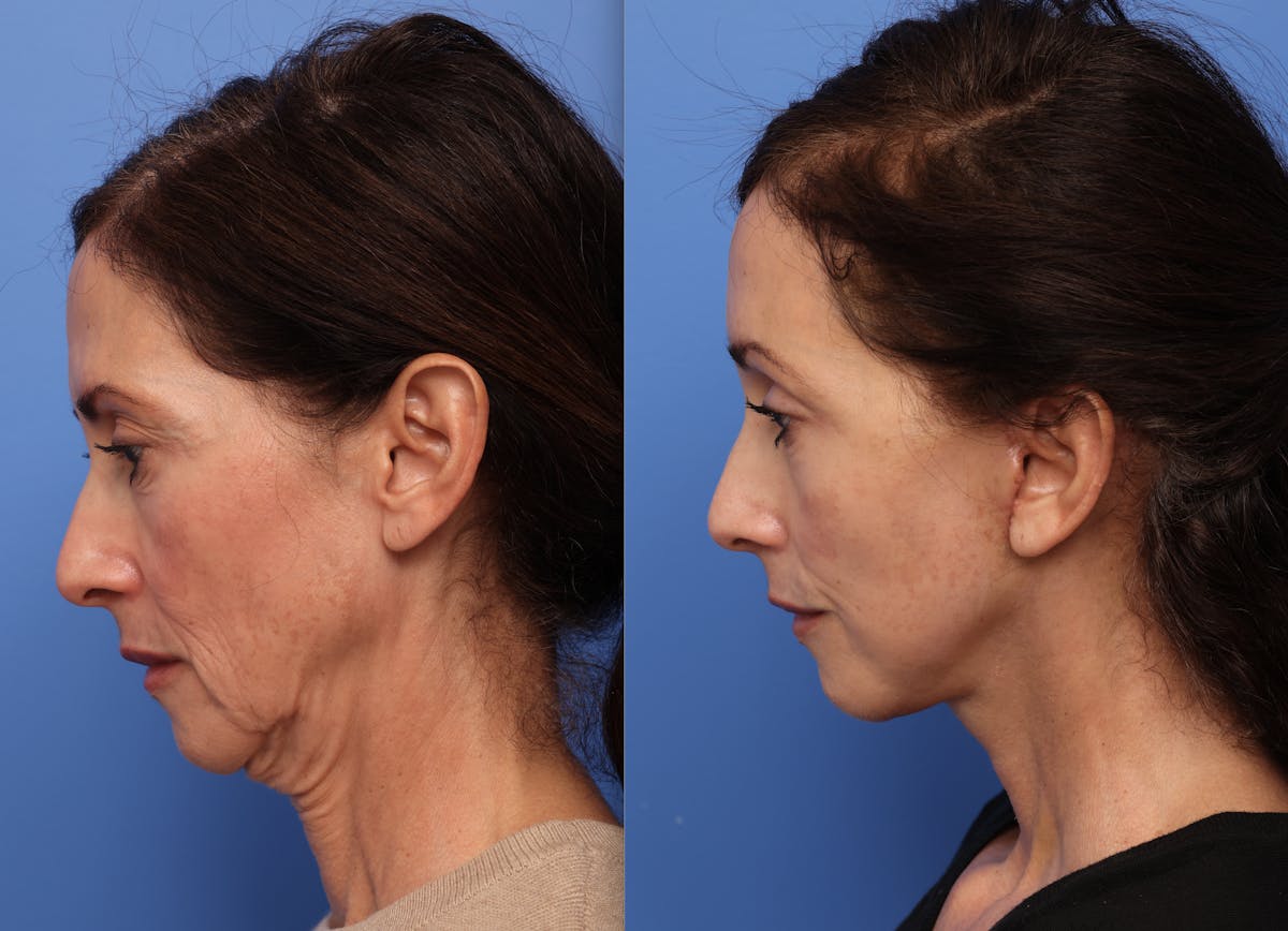 Deep Plane Facelift Before & After Gallery - Patient 140230 - Image 1