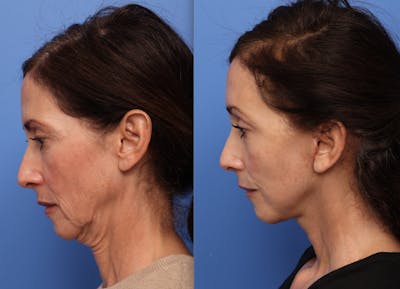 Deep Plane Facelift Before & After Gallery - Patient 140230 - Image 1