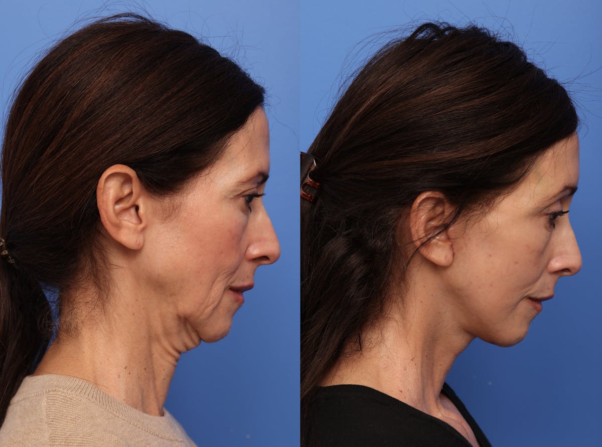 Deep Plane Facelift Before & After Gallery - Patient 140230 - Image 3