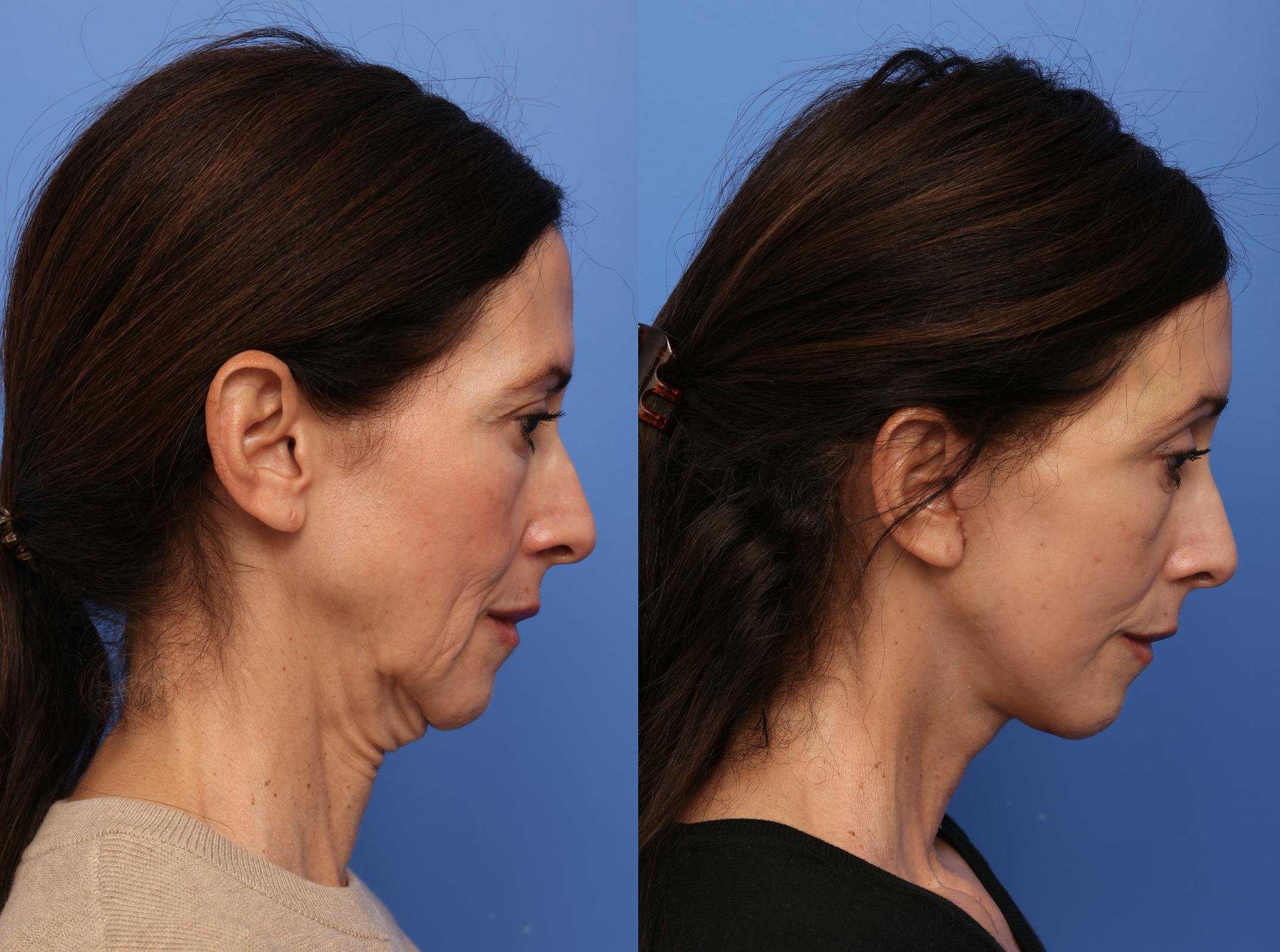 Deep Plane Facelift Before & After Gallery - Patient 140230 - Image 3