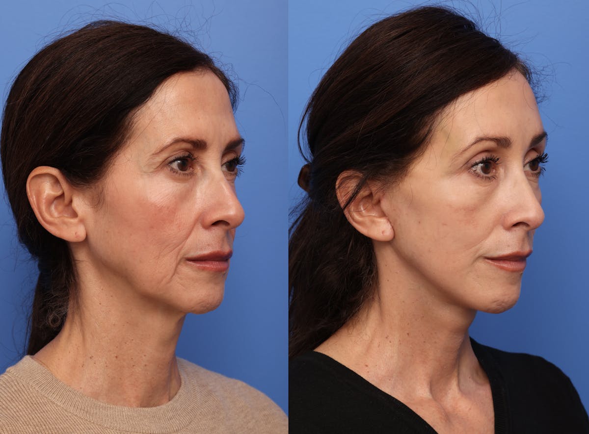 Deep Plane Facelift Before & After Gallery - Patient 140230 - Image 4