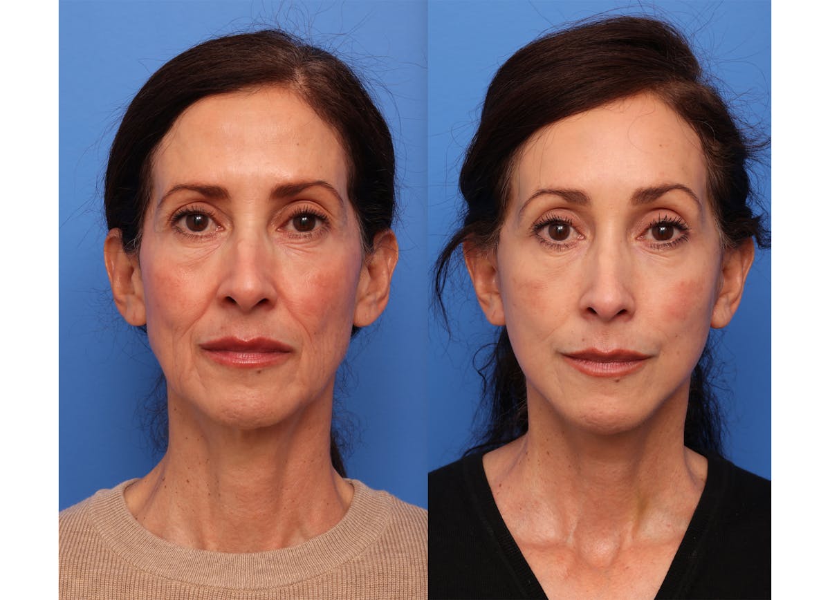 Deep Plane Facelift Before & After Gallery - Patient 140230 - Image 2