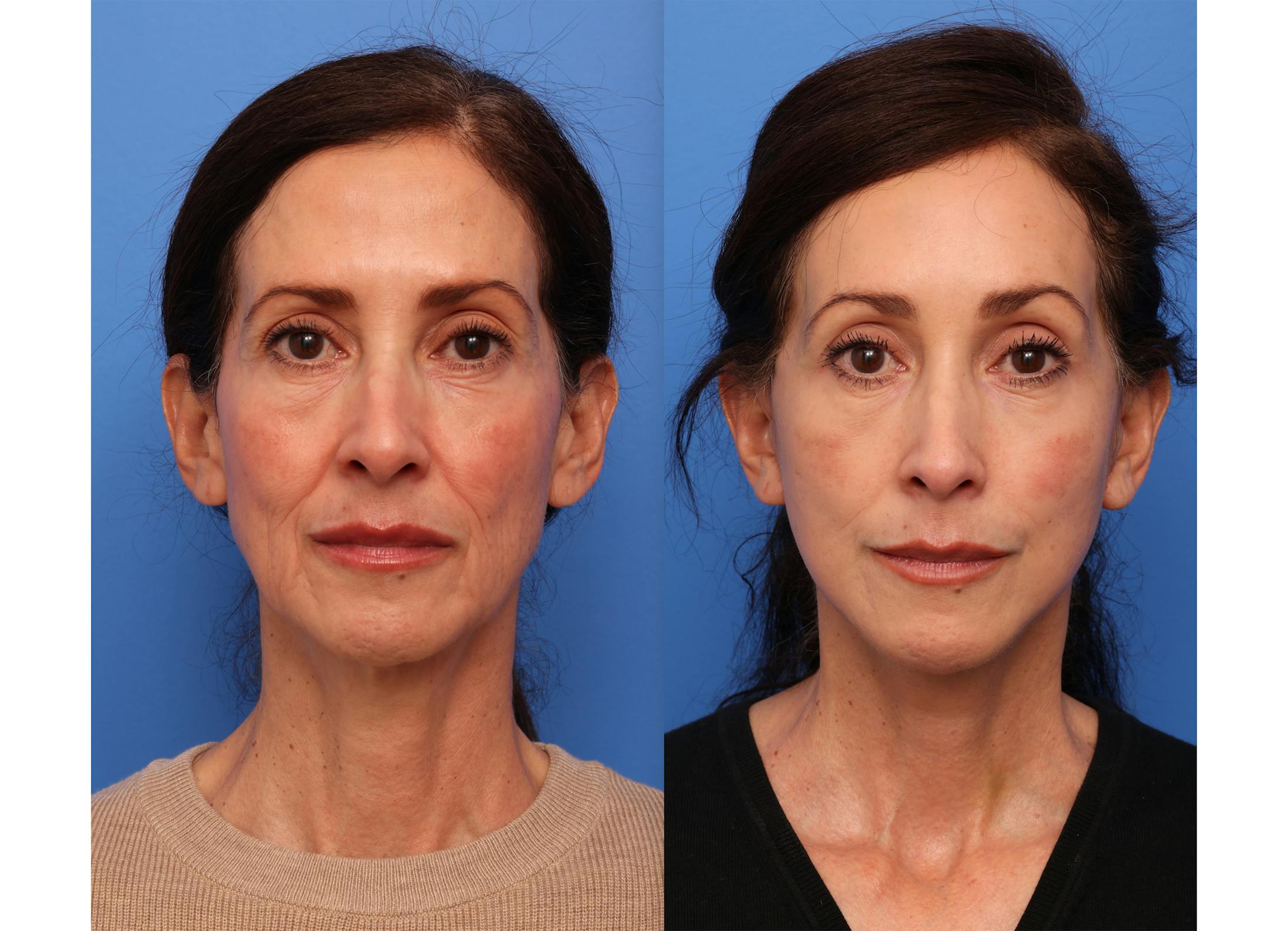 Deep Plane Facelift Before & After Gallery - Patient 140230 - Image 2