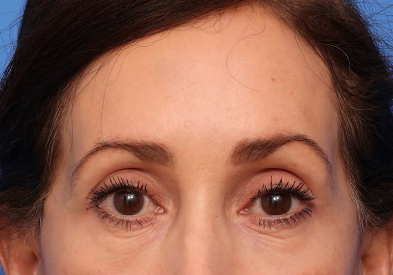 Brow Lift / Forehead Lift Before & After Gallery - Patient 339588 - Image 2