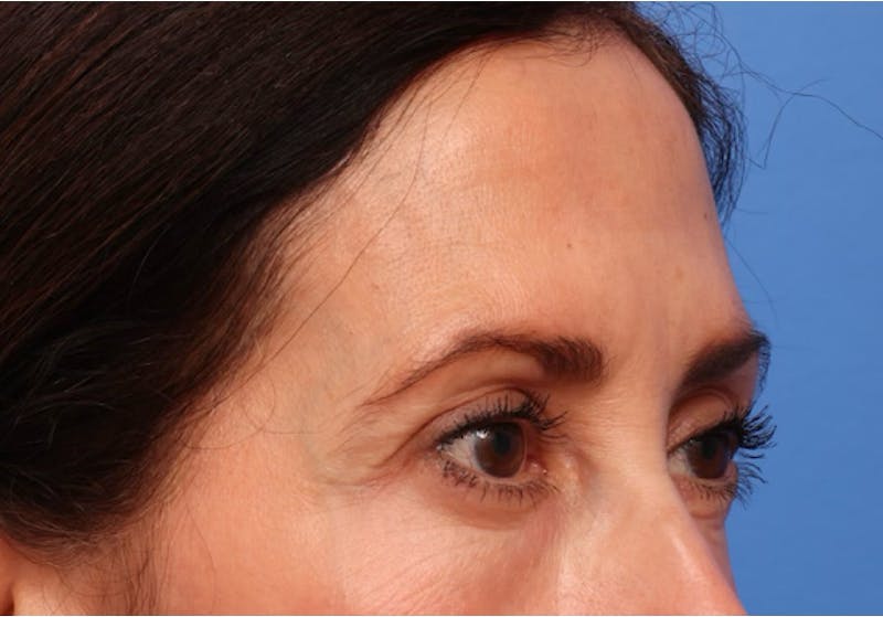 Brow Lift / Forehead Lift Before & After Gallery - Patient 339588 - Image 3