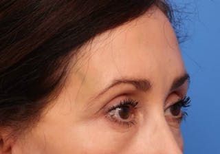 Brow Lift / Forehead Lift Before & After Gallery - Patient 339588 - Image 4