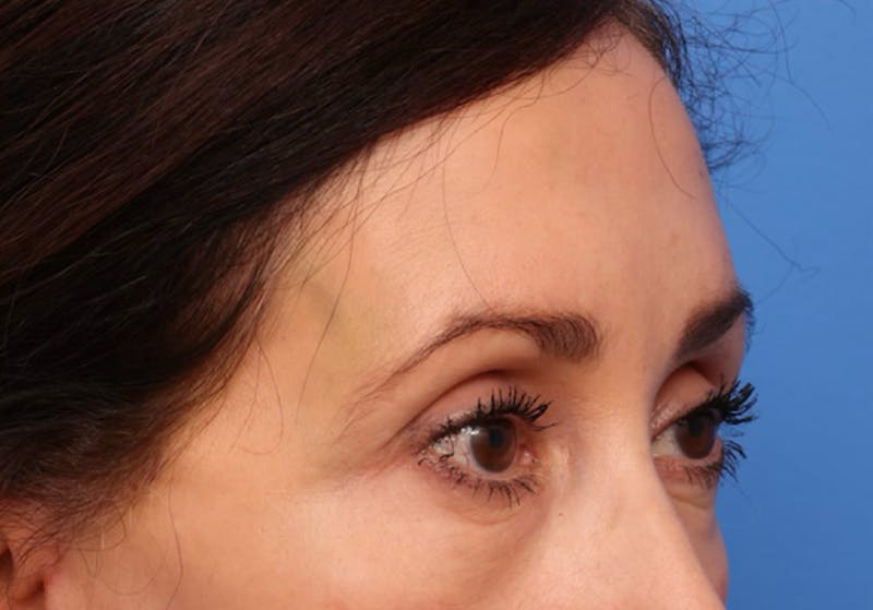 Brow Lift / Forehead Lift Before & After Gallery - Patient 339588 - Image 4