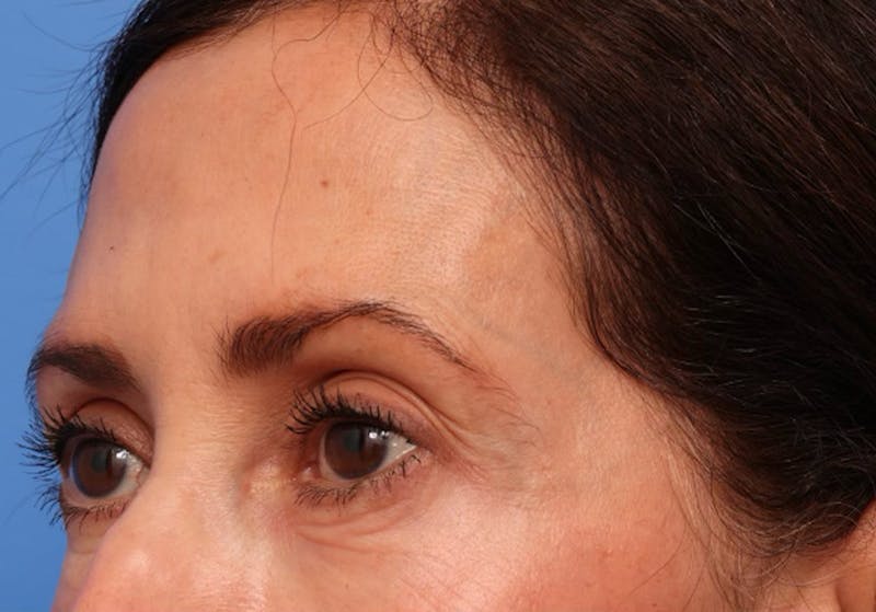 Brow Lift / Forehead Lift Before & After Gallery - Patient 339588 - Image 7