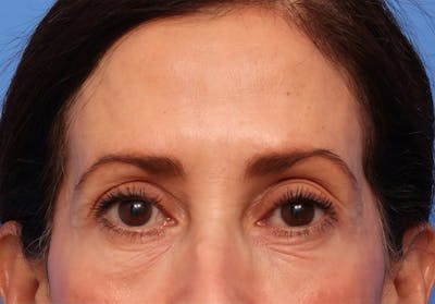Brow Lift / Forehead Lift Before & After Gallery - Patient 339588 - Image 1