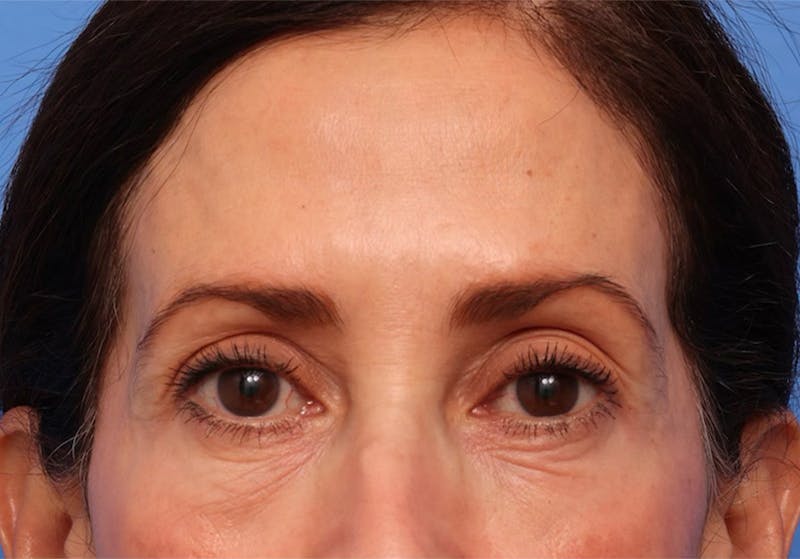 Brow Lift / Forehead Lift Before & After Gallery - Patient 339588 - Image 1