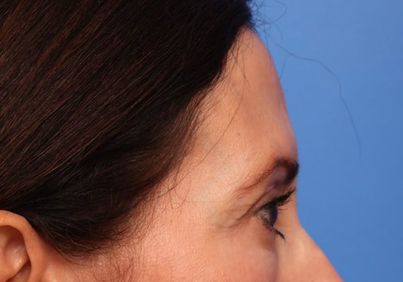 Brow Lift / Forehead Lift Before & After Gallery - Patient 339588 - Image 5