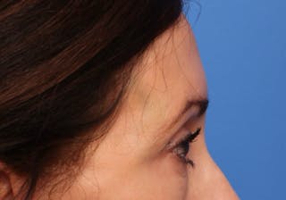 Brow Lift / Forehead Lift Before & After Gallery - Patient 339588 - Image 6