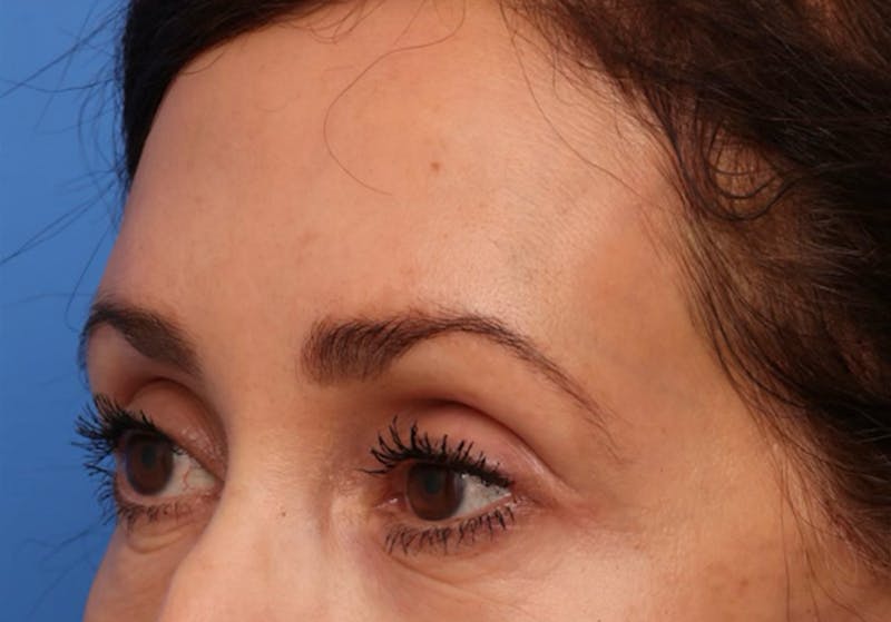 Brow Lift / Forehead Lift Before & After Gallery - Patient 339588 - Image 8