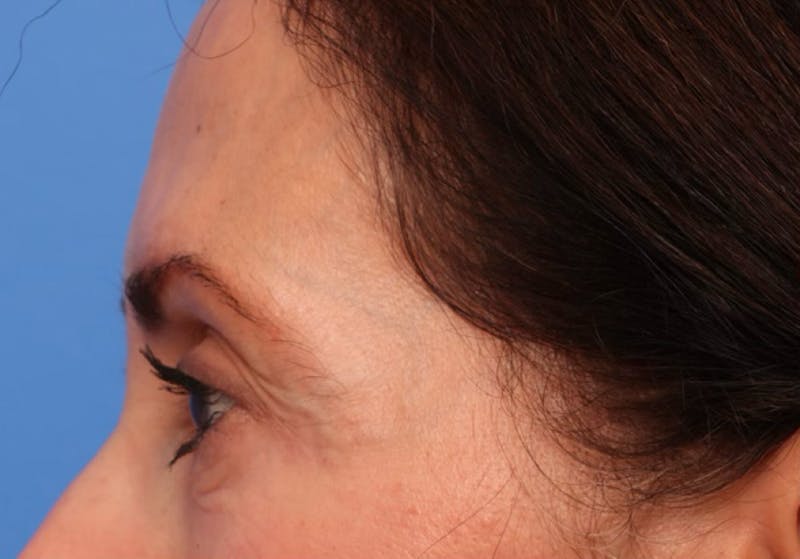 Brow Lift / Forehead Lift Before & After Gallery - Patient 339588 - Image 9