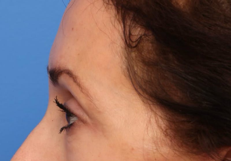 Brow Lift / Forehead Lift Before & After Gallery - Patient 339588 - Image 10