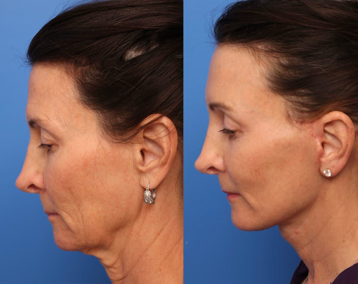 Deep Plane Facelift Before & After Gallery - Patient 345058 - Image 2