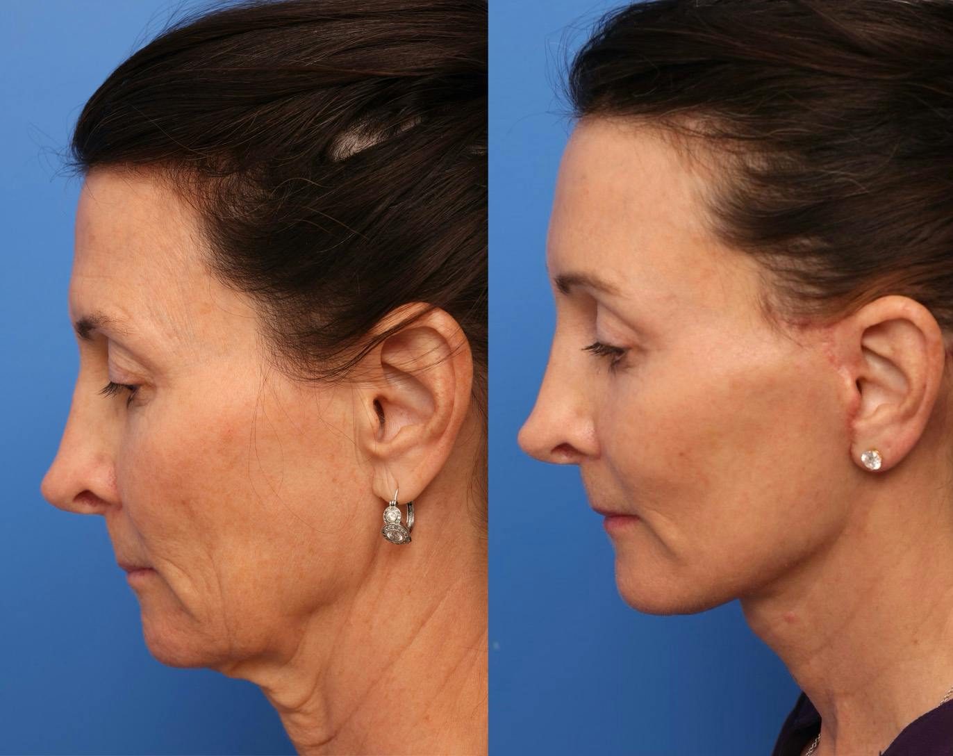 Deep Plane Facelift Before & After Gallery - Patient 345058 - Image 2