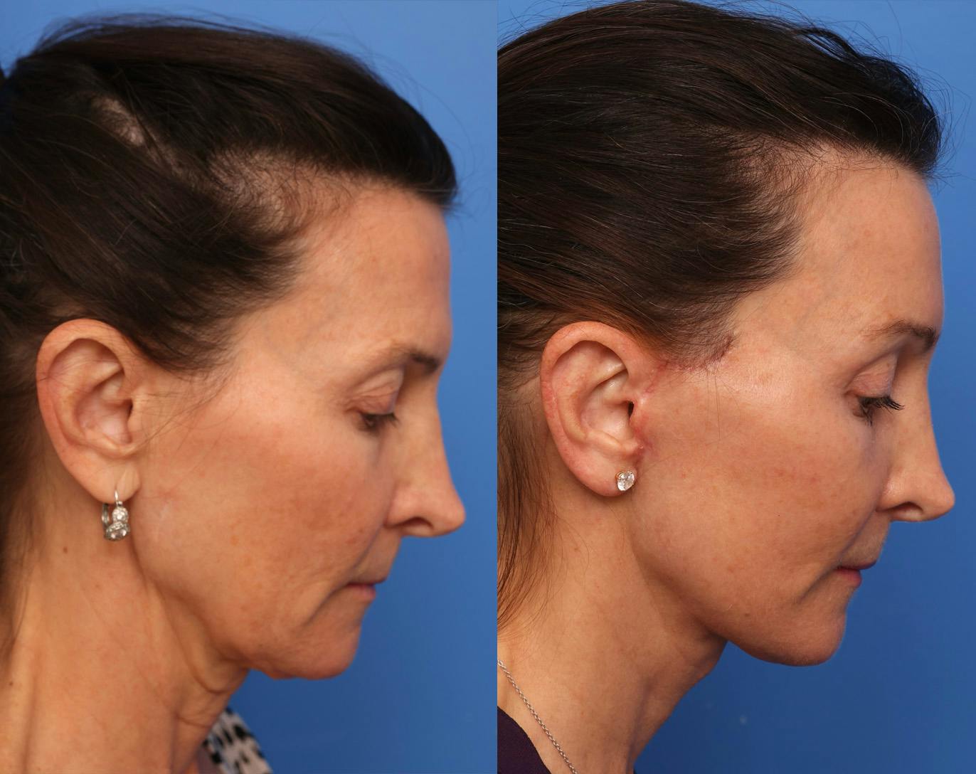 Deep Plane Facelift Before & After Gallery - Patient 345058 - Image 4