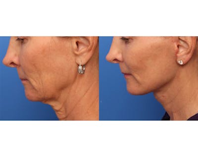 Deep Plane Facelift Before & After Gallery - Patient 345058 - Image 1