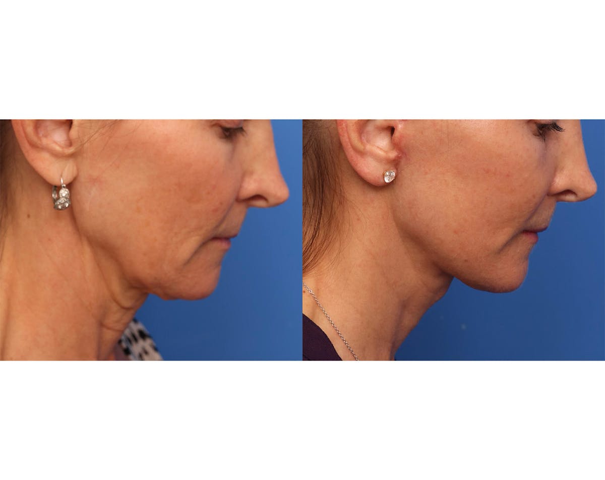 Deep Plane Facelift Before & After Gallery - Patient 345058 - Image 3