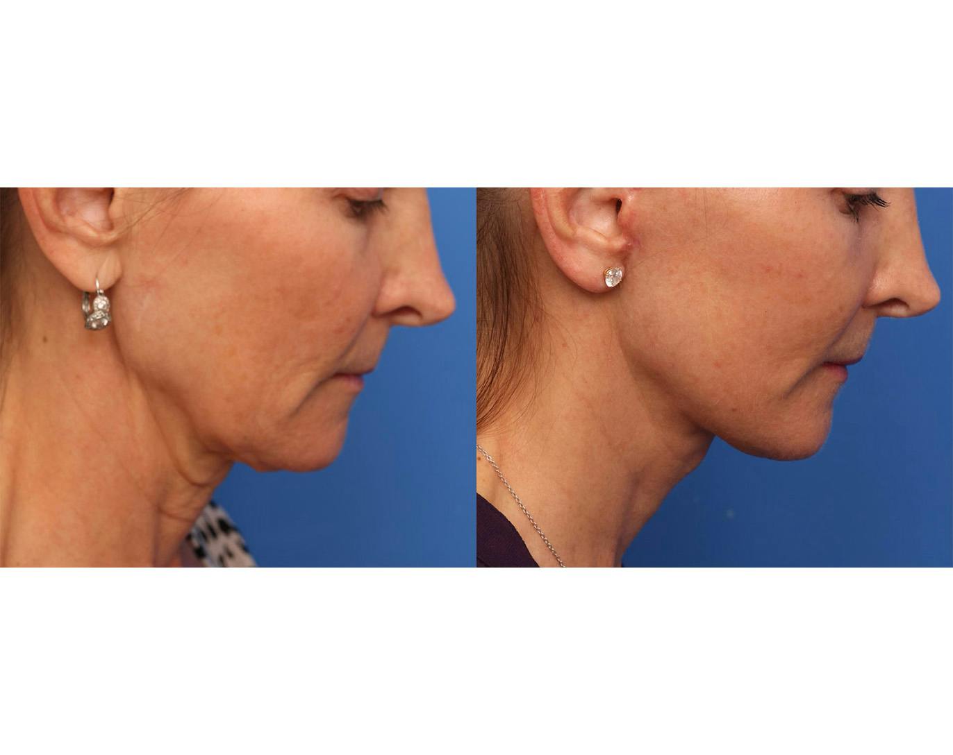 Deep Plane Facelift Before & After Gallery - Patient 345058 - Image 3