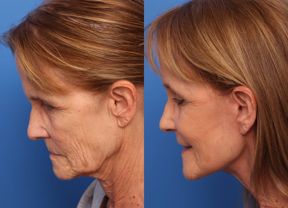 Deep Plane Facelift Before & After Gallery - Patient 319818 - Image 1