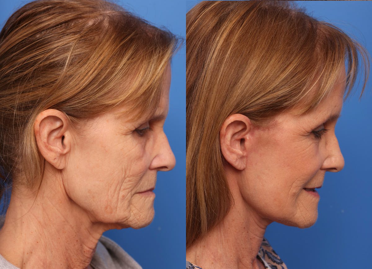 Deep Plane Facelift Before & After Gallery - Patient 319818 - Image 2