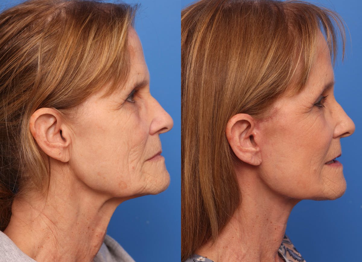 Deep Plane Facelift Before & After Gallery - Patient 319818 - Image 3