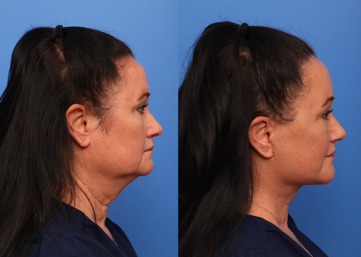Neck Lift Before & After Gallery - Patient 190679 - Image 2