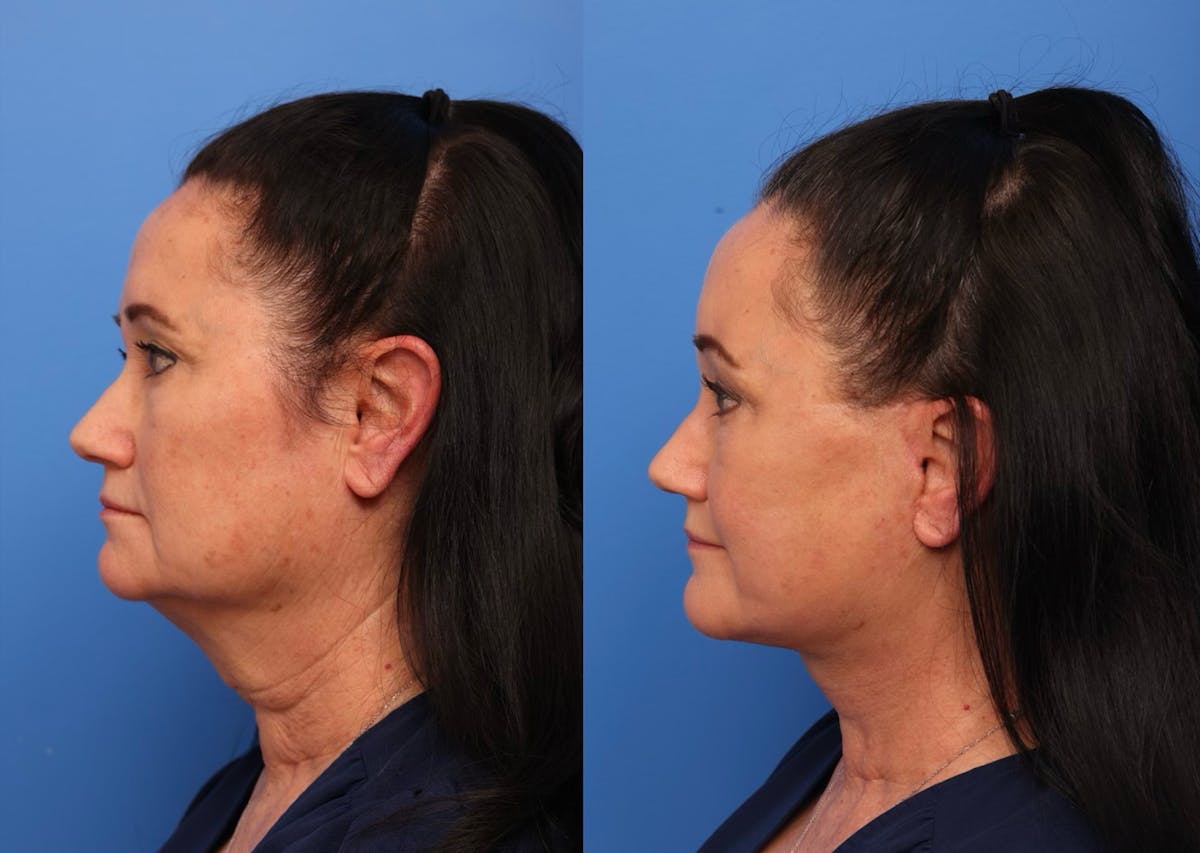 Neck Lift Before & After Gallery - Patient 190679 - Image 6