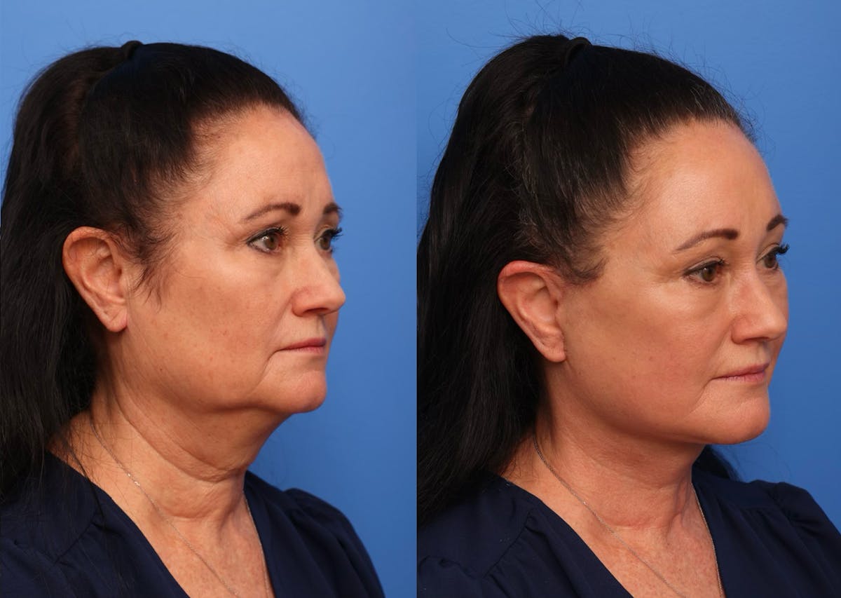 Neck Lift Before & After Gallery - Patient 190679 - Image 3