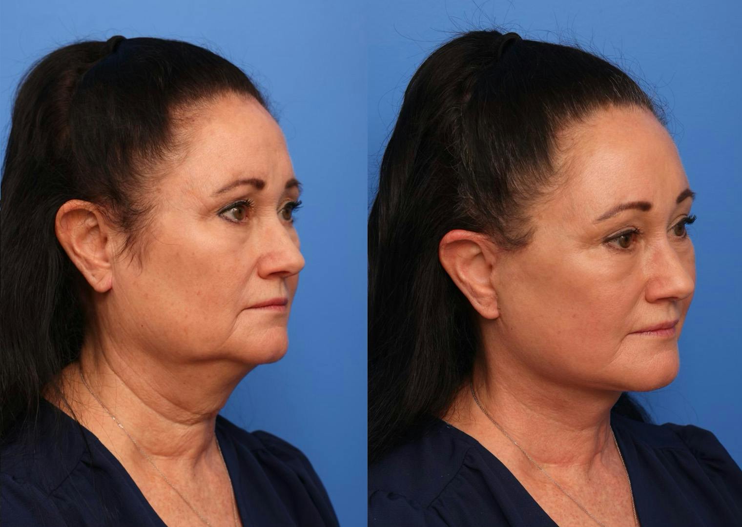 Deep Plane Facelift Before & After Gallery - Patient 240586 - Image 3