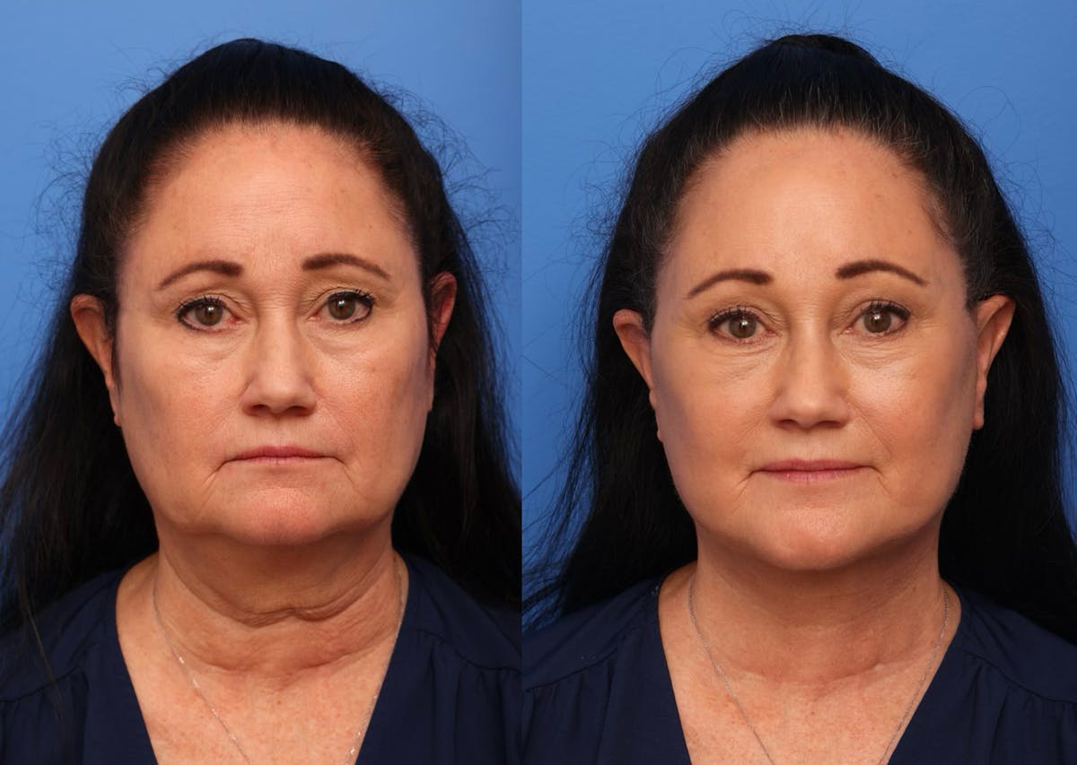 Neck Lift Before & After Gallery - Patient 190679 - Image 4