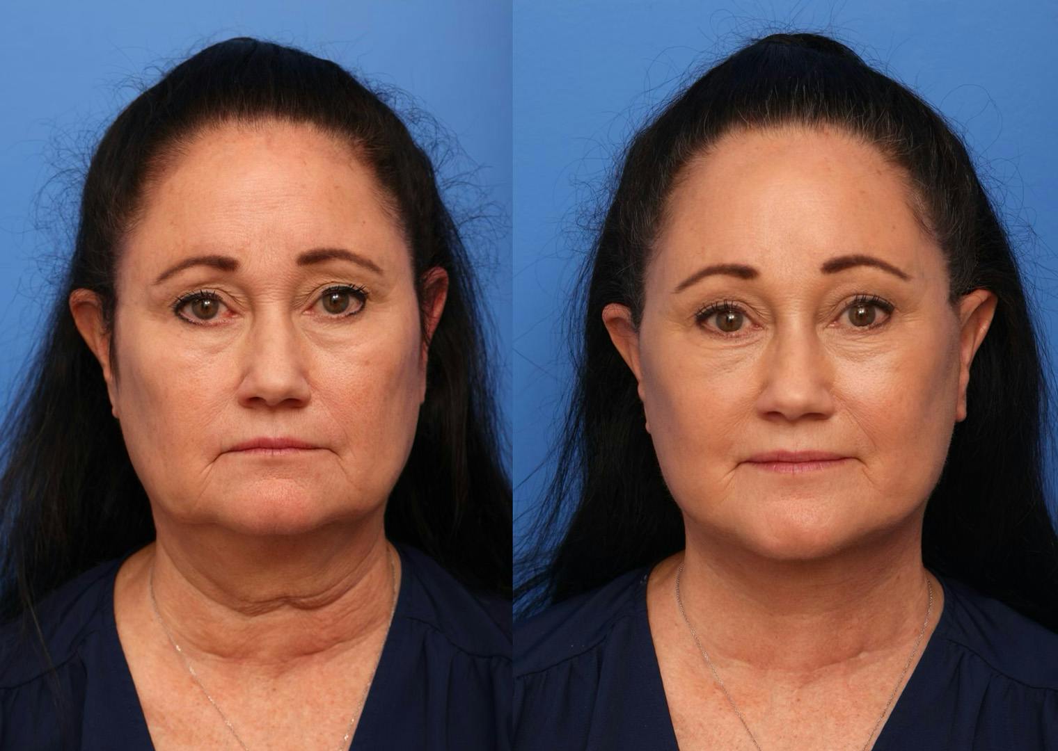 Deep Plane Facelift Before & After Gallery - Patient 240586 - Image 4