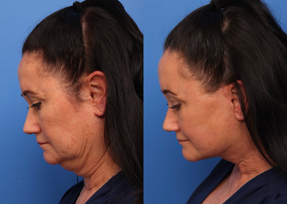 Neck Lift Before & After Gallery - Patient 190679 - Image 5