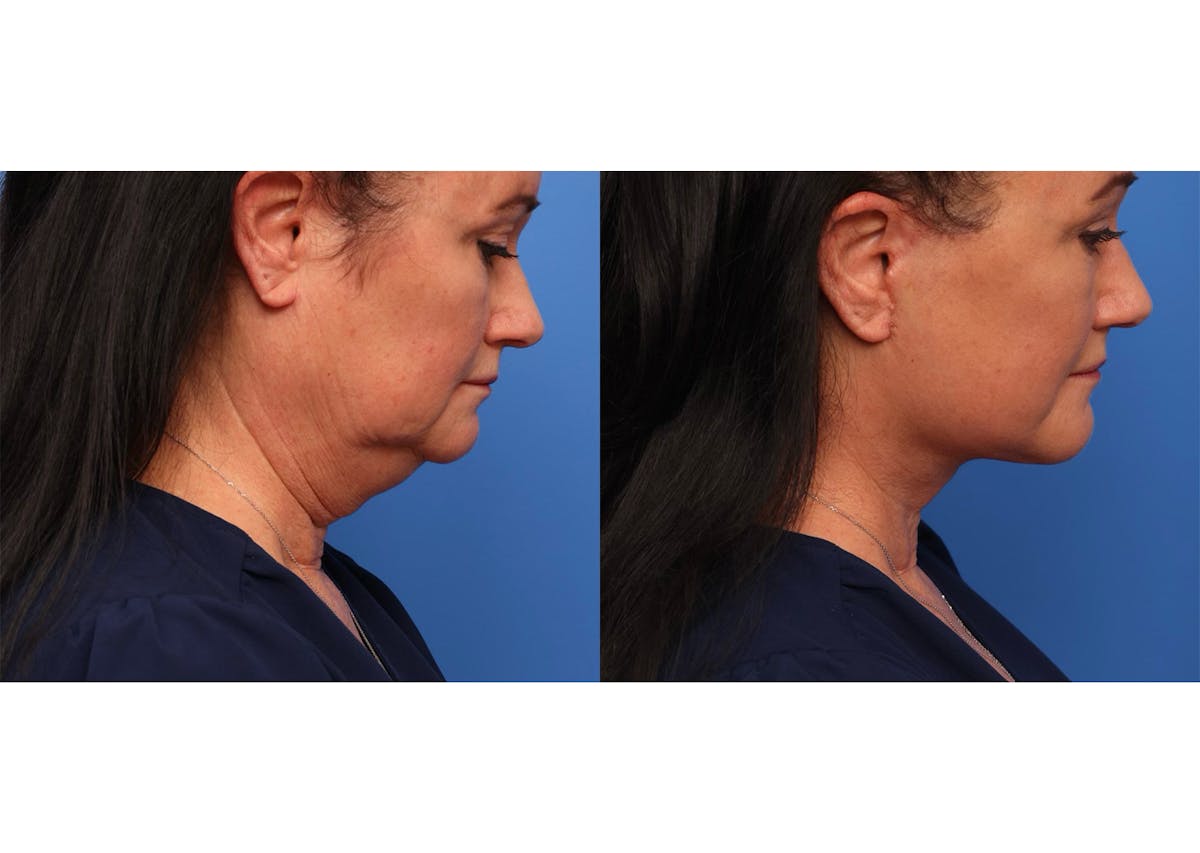Neck Lift Before & After Gallery - Patient 190679 - Image 1