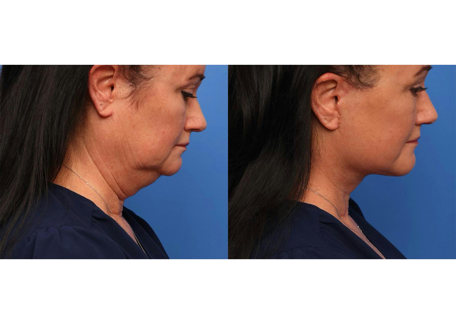 Deep Plane Facelift Before & After Gallery - Patient 240586 - Image 1