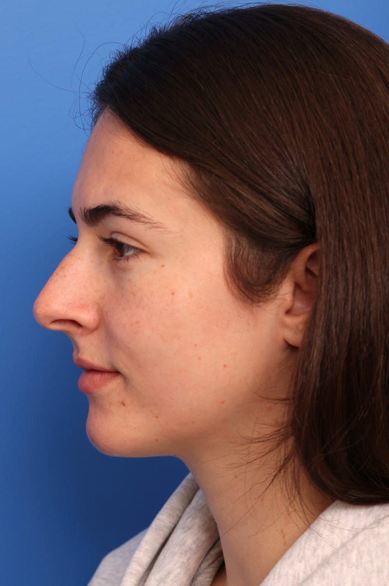 Rhinoplasty Before & After Gallery - Patient 228843 - Image 1