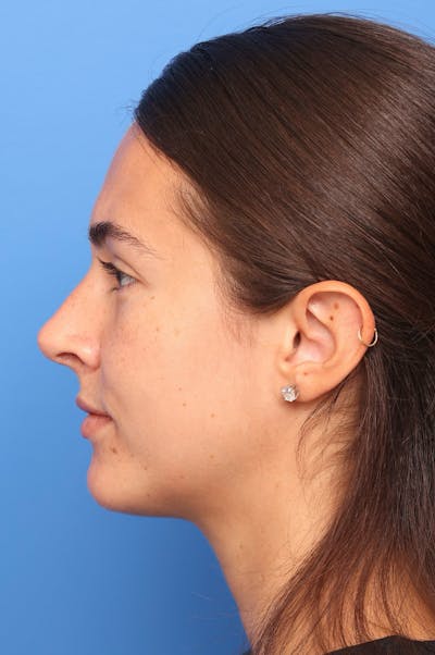 Rhinoplasty Before & After Gallery - Patient 228843 - Image 2