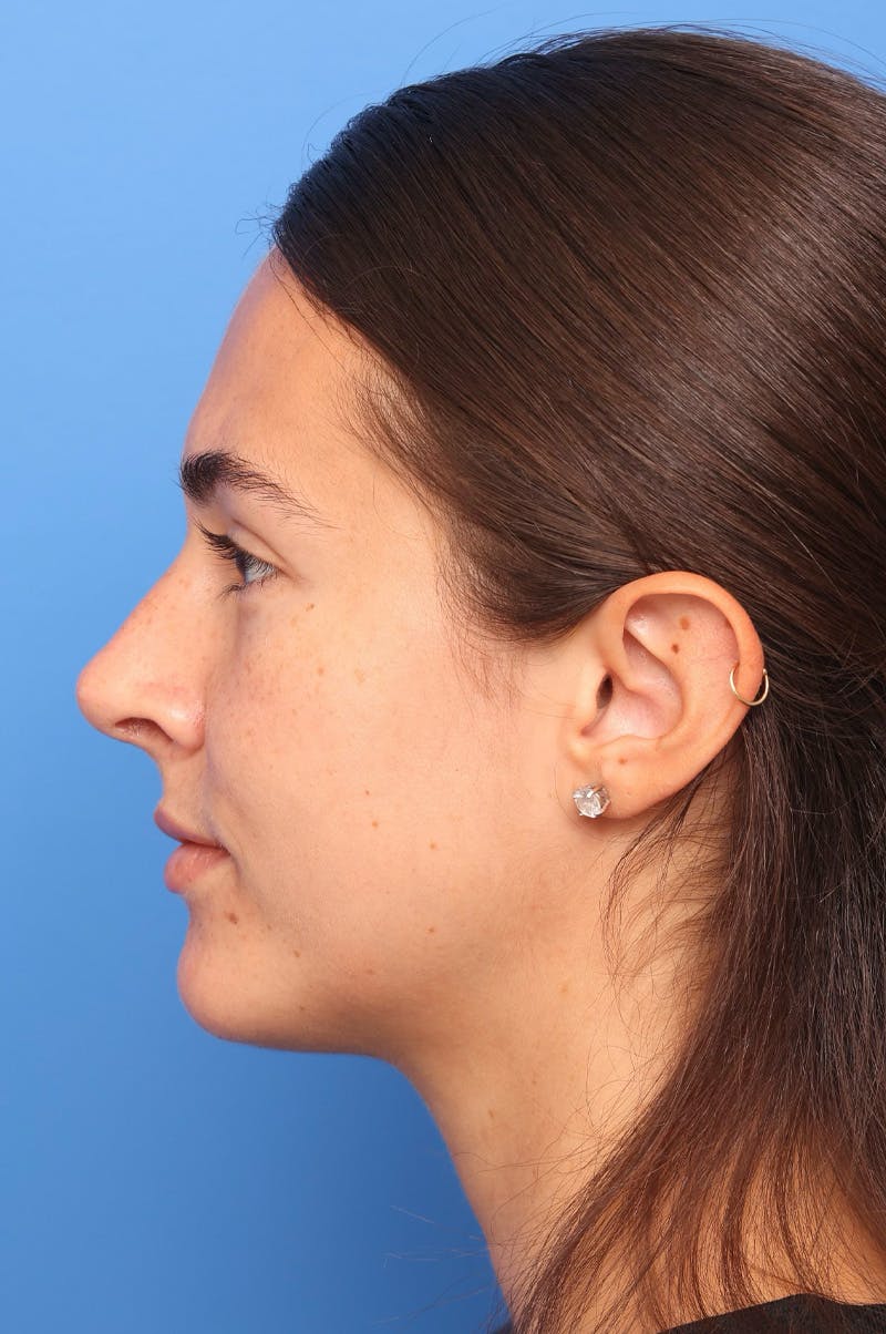 Rhinoplasty Before & After Gallery - Patient 228843 - Image 2