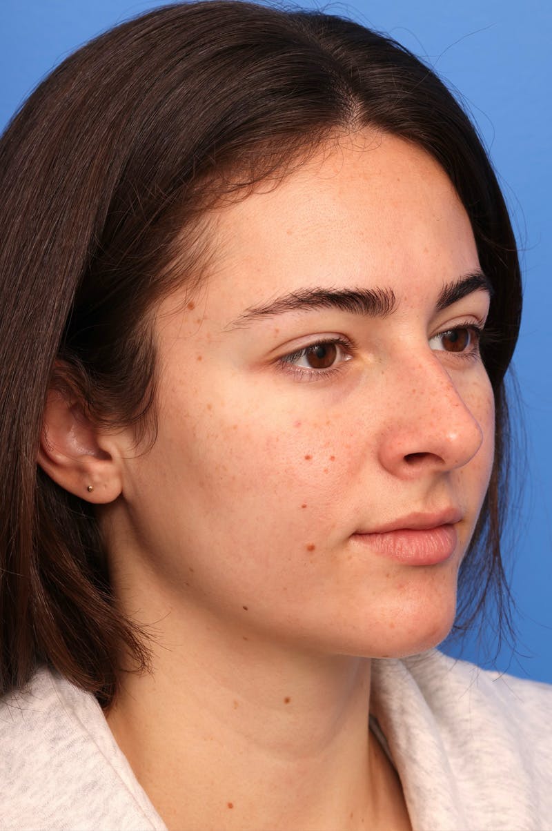 Rhinoplasty Before & After Gallery - Patient 228843 - Image 3