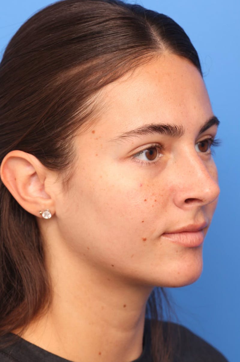 Rhinoplasty Before & After Gallery - Patient 228843 - Image 4