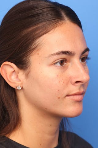 Rhinoplasty Before & After Gallery - Patient 228843 - Image 4